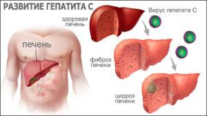Профилактика гепатита C
